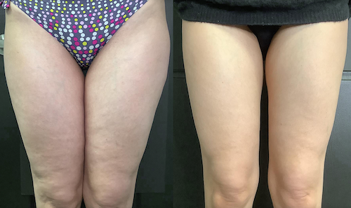 Thigh Fat Reduction Body Contouring Before After Mississauga Oakville